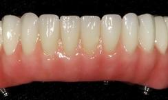 Prothèse Fixe Fix-On-Zircon Fixed Denture Fix-On-Zircon Brossard-Laprairie