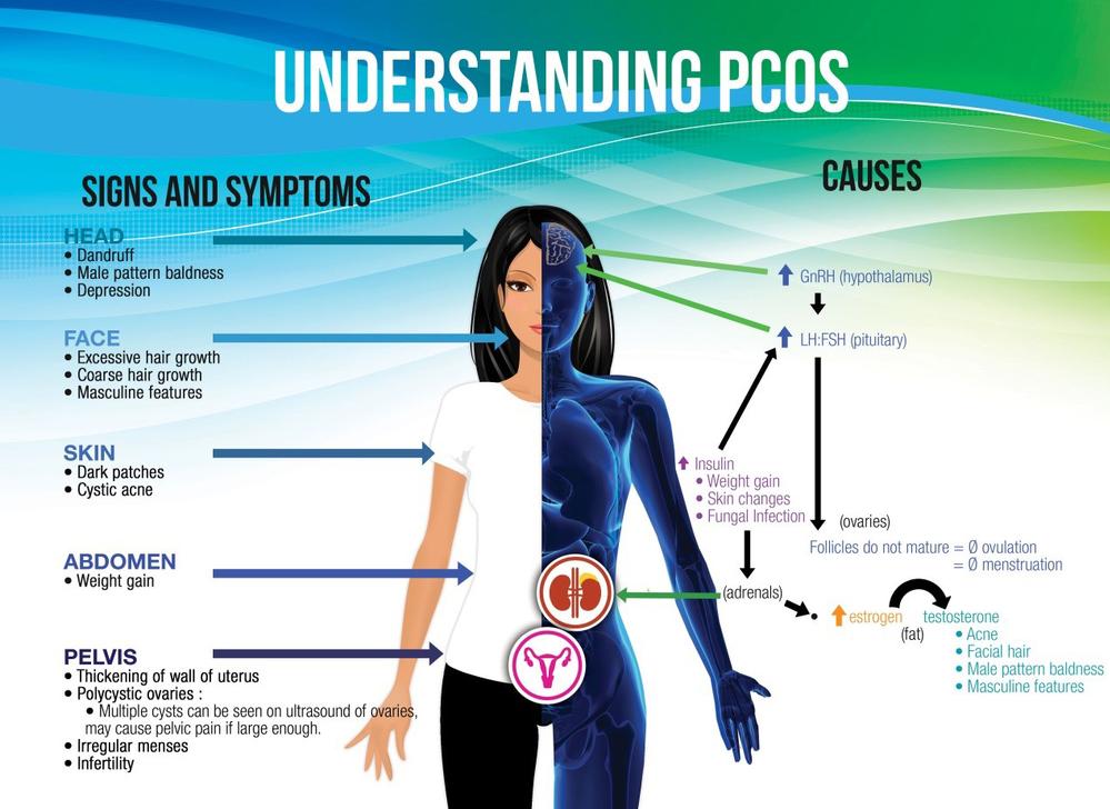 Understanding PCOS