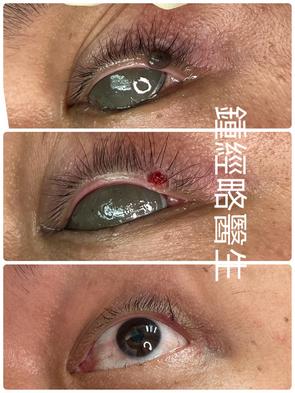a serial of pictures of removal of a black skin mole locates on the external margin of the upper eyelid