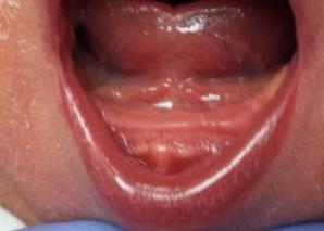 diagnosing a posterior tongue tie