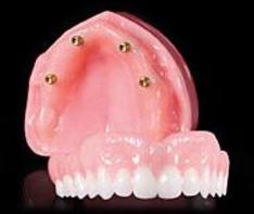 Denture On Implants Michel Puertas Denturologiste Brossard-Laprairie