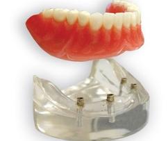 Denture On Implants Michel Puertas Denturologiste Brossard-Laprairie