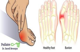 Whole Foot Pain - Buderim Podiatry