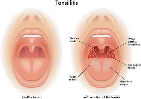 Tonsillitis – Causes and Risk Factors, Pathophysiology, Clinical Manifestations, Diagnostic Evaluations and Management