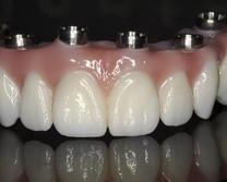 Prothèse Fixe Sur Implants Brossard-Laprairie