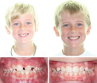 3 Benefits of Braces for Kids