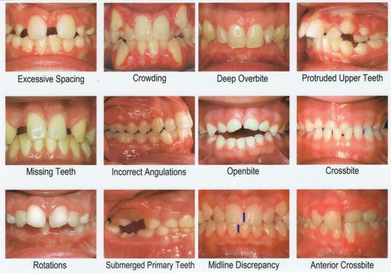 underbite overbite