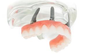 Prothèse Dentaire Fixe Sur Implants Michel Puertas Denturologiste Brossard-Laprairie, Fixed Denture On Implants Michel Puertas Denturologiste Brossard-Laprairie