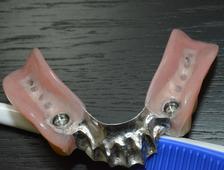 Partial Denture On Implants Clinique Implantologie Dentaire