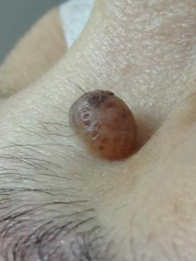 另一角度近鏡觀察一粒位於眉毛下方，近鼻樑位置的，淺啡色的， 凸出皮膚表面的墨痣