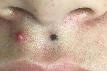 image of a flat black skin mole on upper cutaneous lip