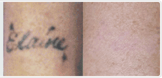ThINK Tattoo Removal Cream