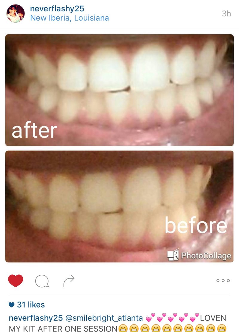 Before And After Pics Smile Bright Teeth Whitening