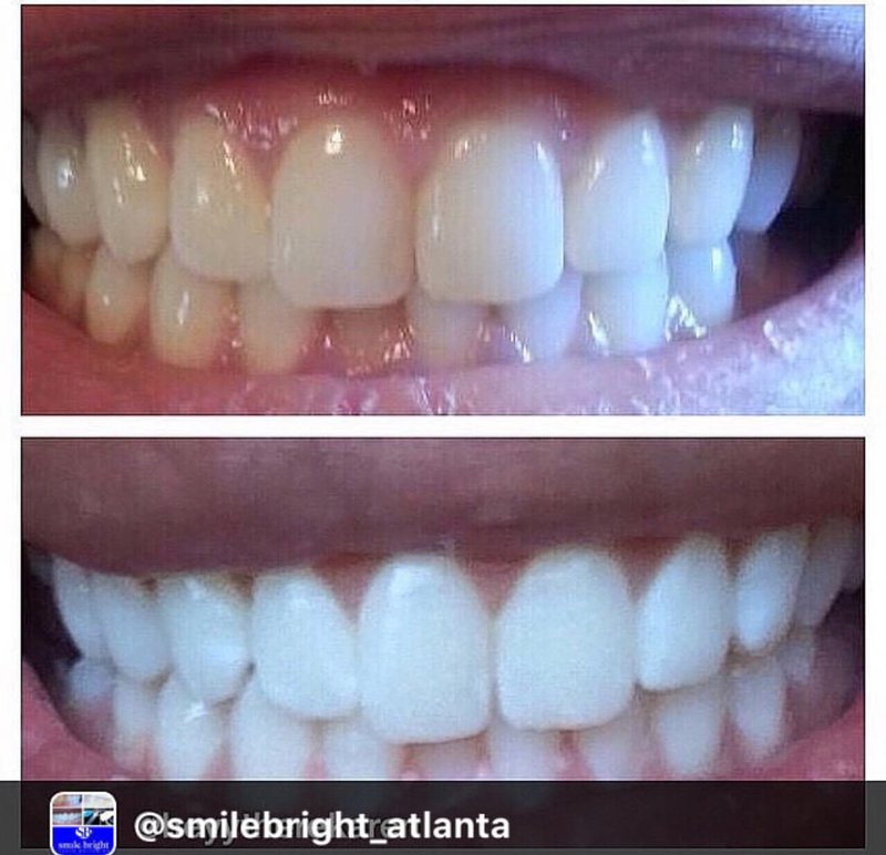Before And After Pics Smile Bright Teeth Whitening